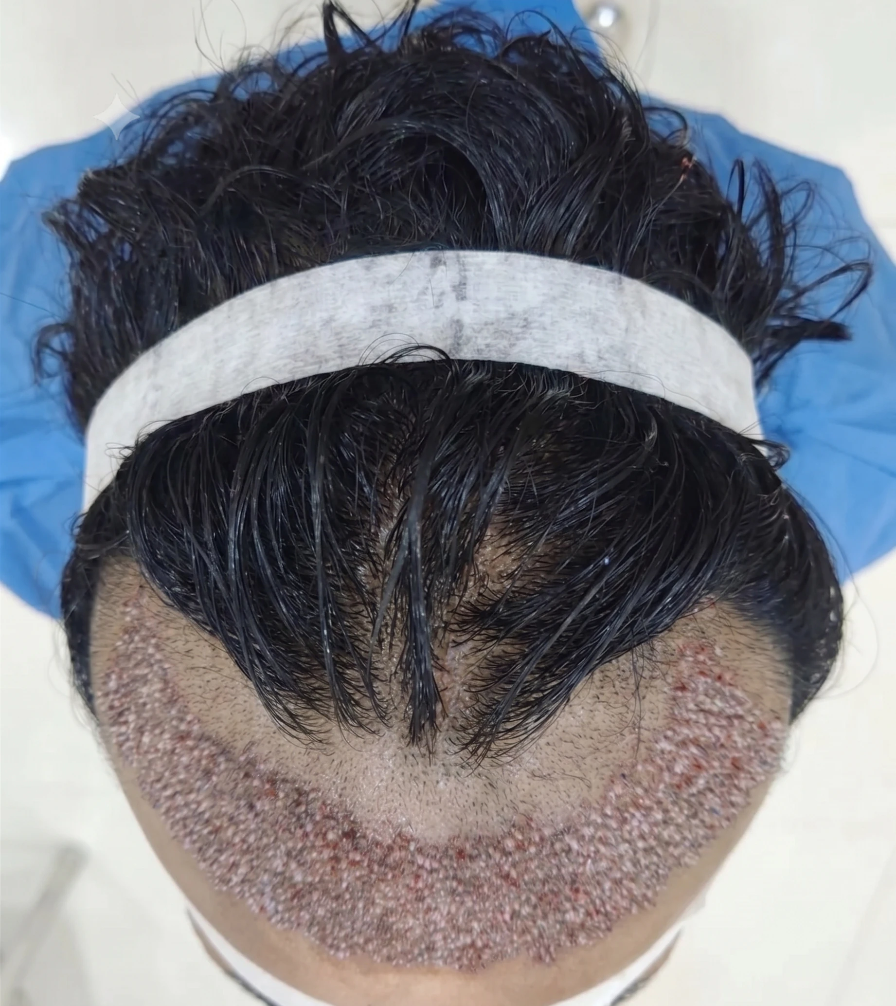 Hairline Transformation before