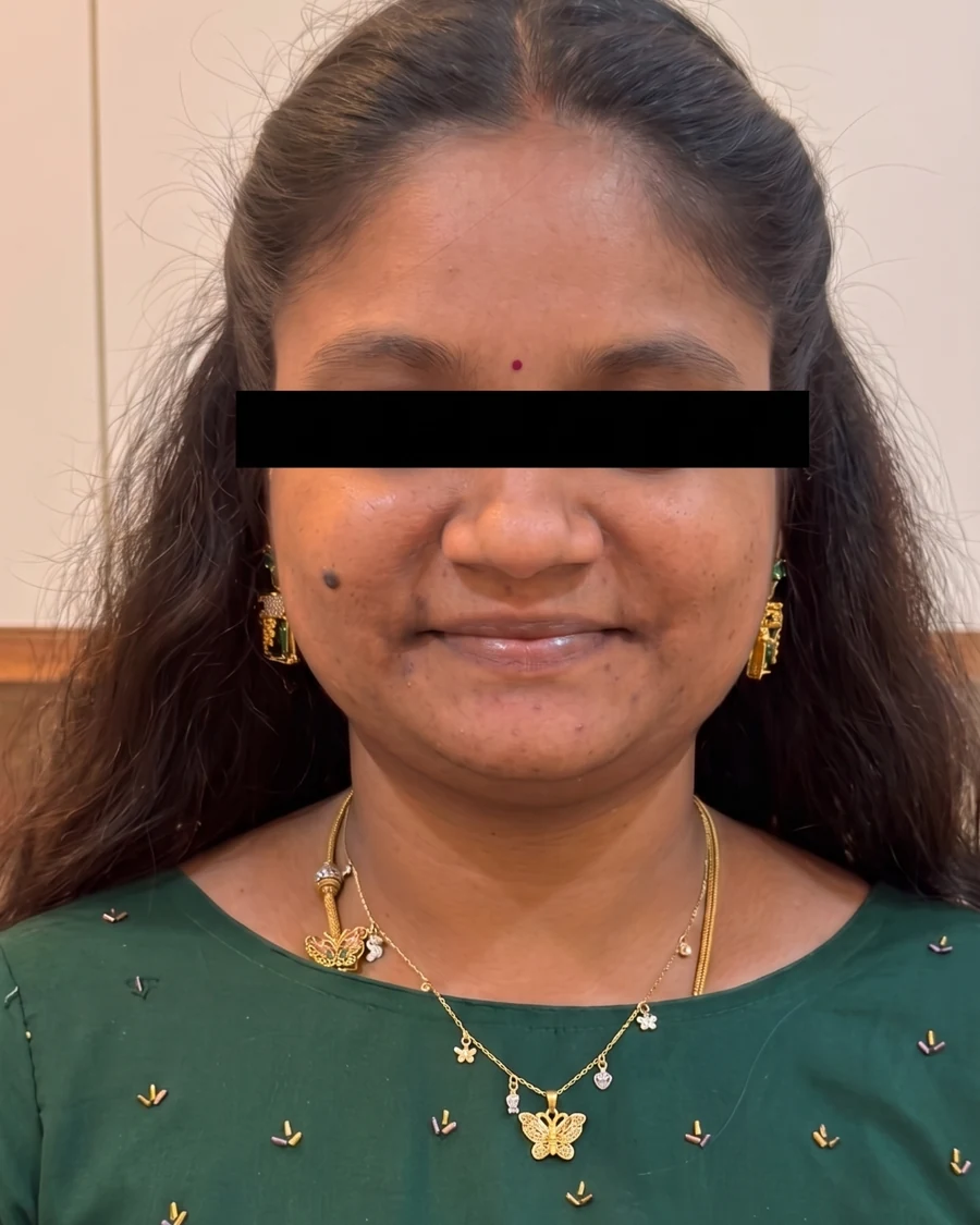 V Lift Treatment Results after