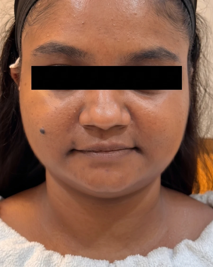 V Lift Treatment Results before