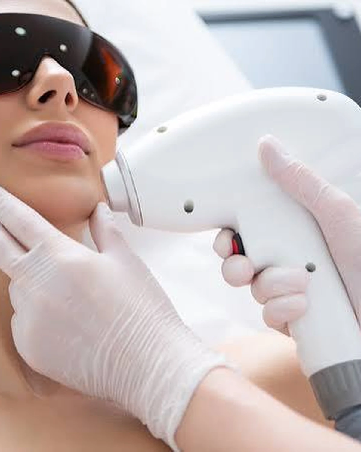 Laser Hair Removal Treatment in Madurai at Dermeon Advanced Skin & Hair Clinic – Safe & Long-Lasting Results