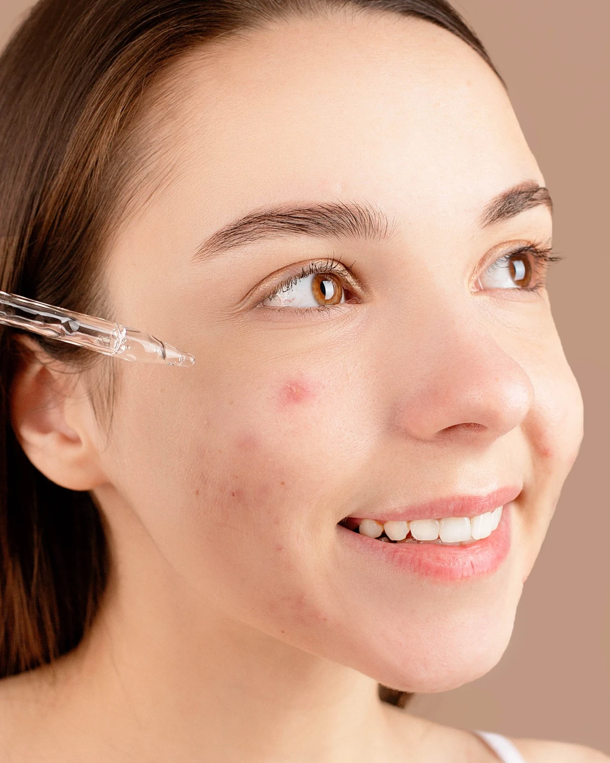 Anti Acne Treatments in Madurai at Dermeon Advanced Skin & Hair Clinic