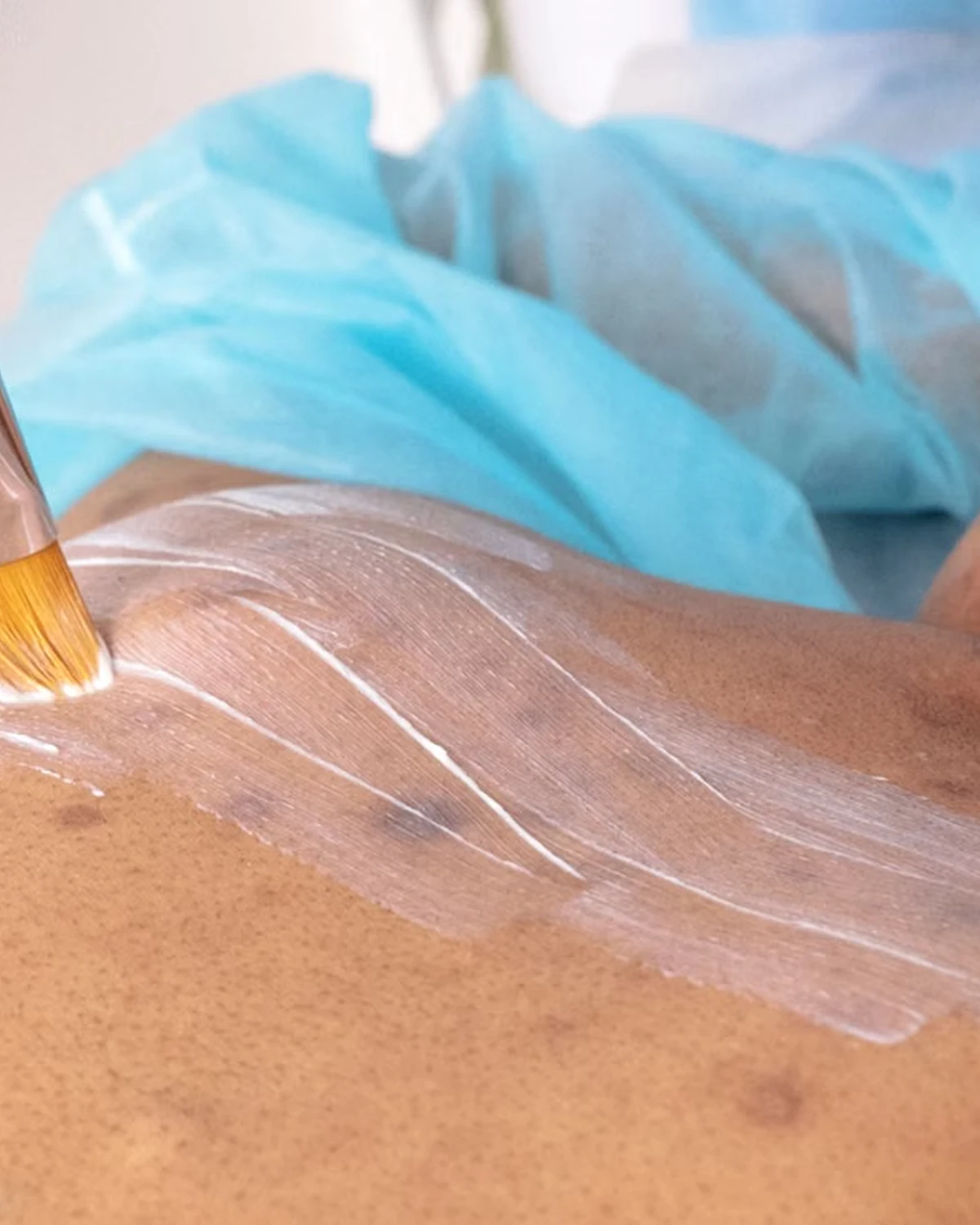Full Body Peels in Madurai at Dermeon Advanced Skin & Hair Clinic