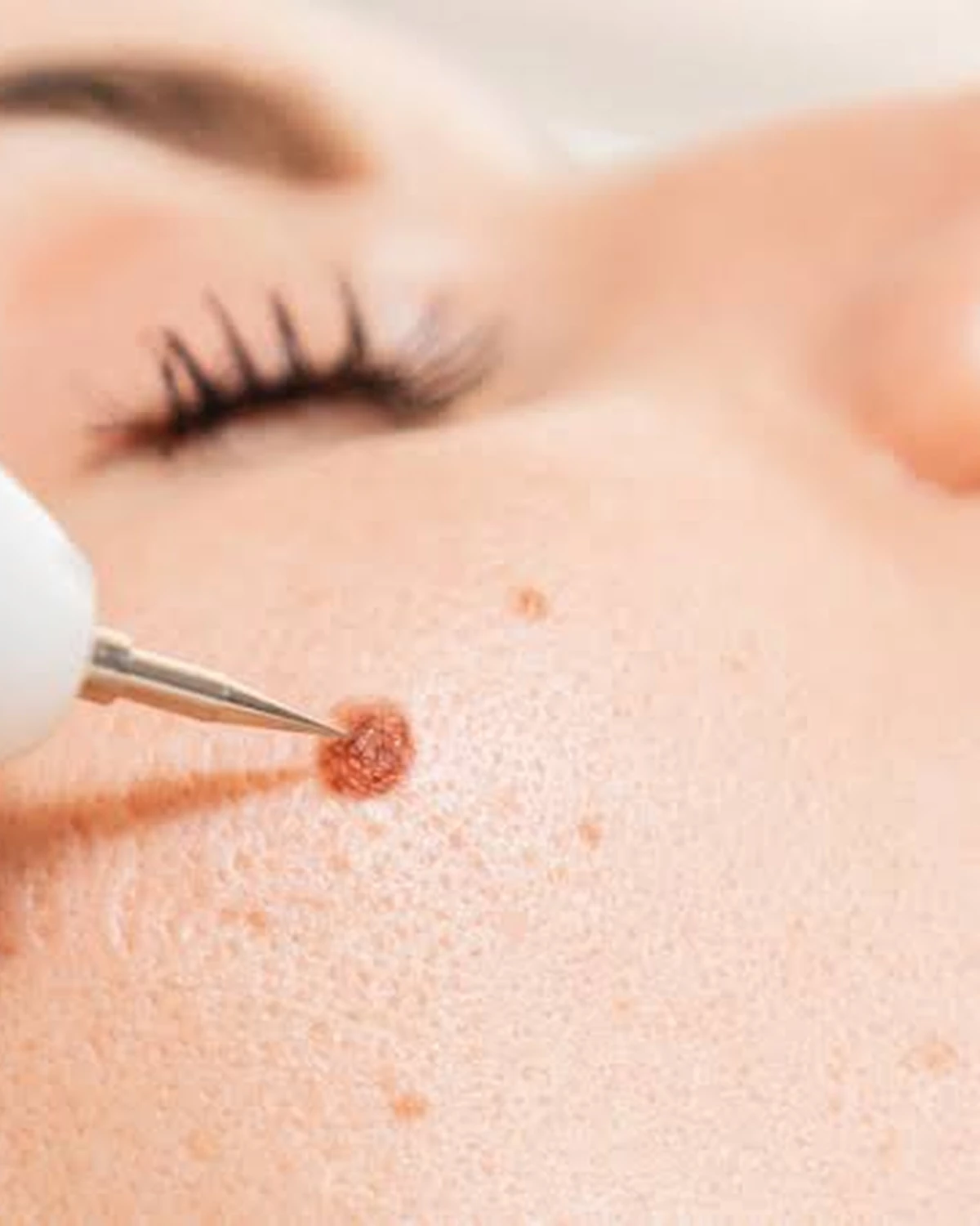 Warts Removal in Madurai at Dermeon Advanced Skin & Hair Clinic